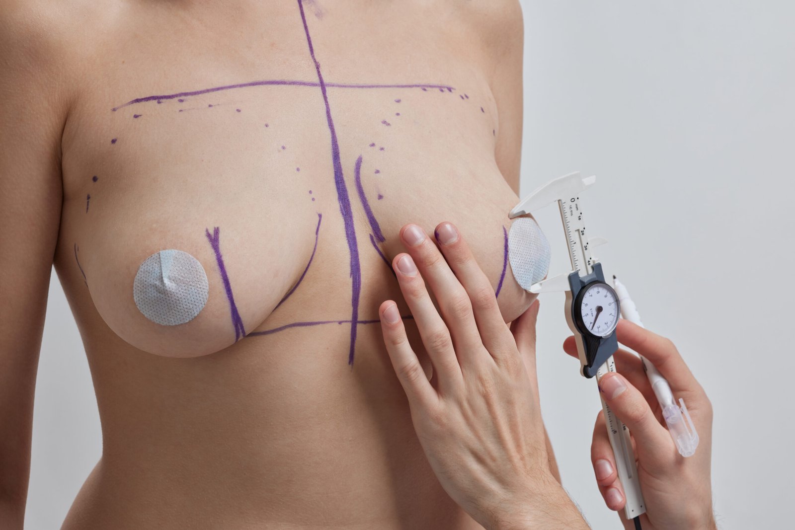 Tecnicas de incision para mastopexia con implantes piruleta y ancla en Estambul