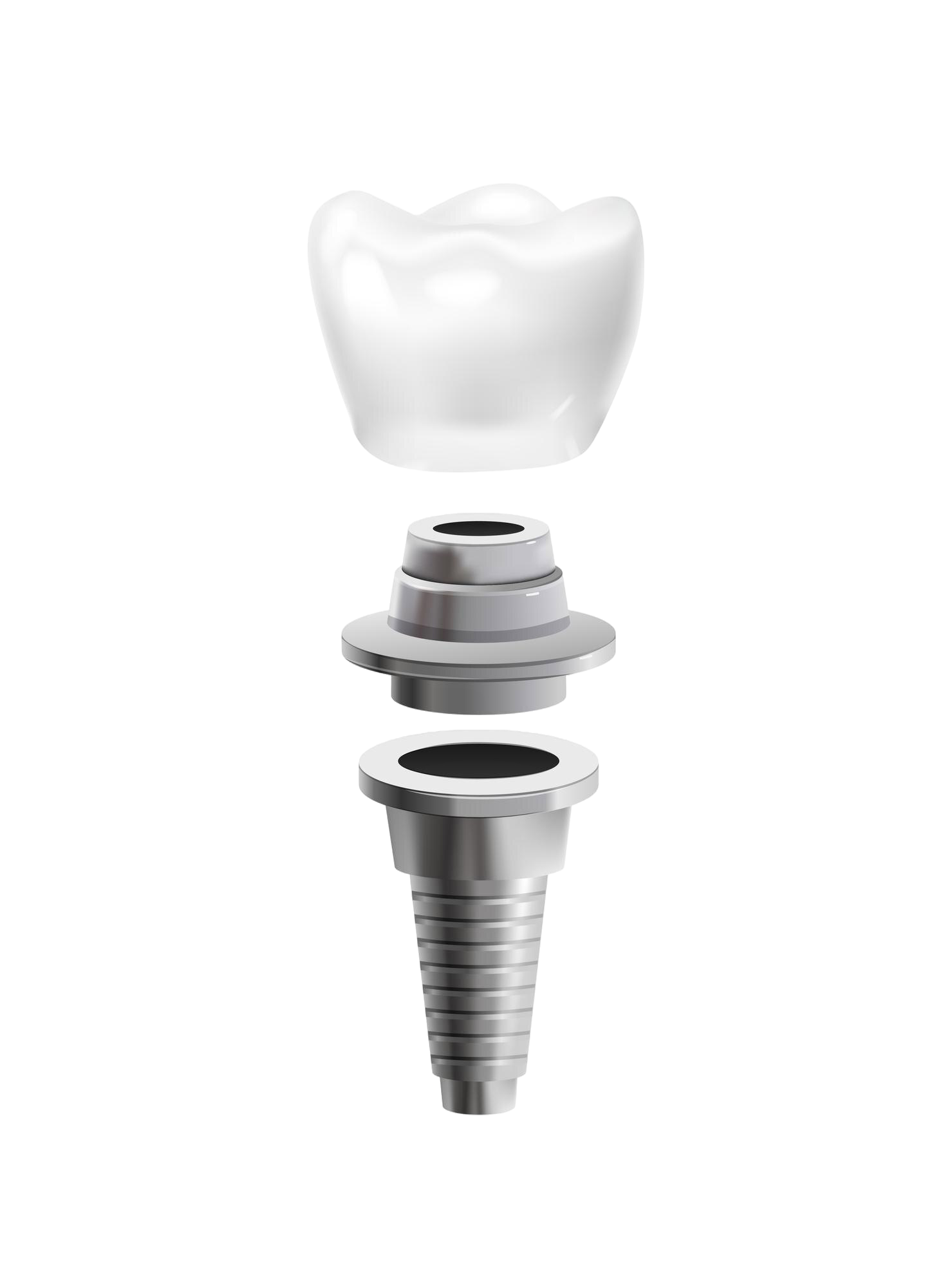 Diferencia entre implantes dentales de titanio y zirconio con ventajas estéticas y funcionales.