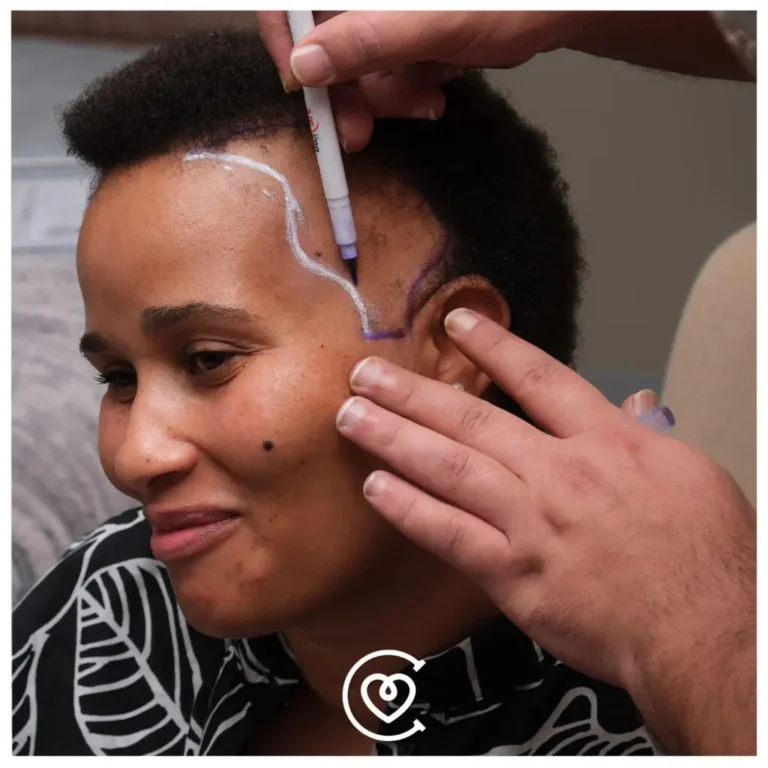 trasplante de cabello en mujeres