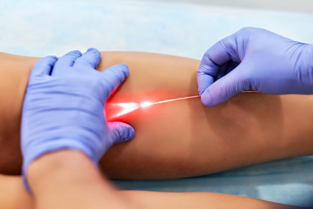 Tratamiento laser endovenoso para varices EVLA en Turquia Cayra Clinic