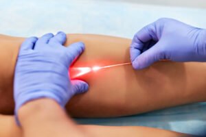 Tratamiento laser endovenoso para varices EVLA en Turquia Cayra Clinic