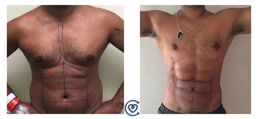 Antes y después de la cirugía de ginecomastia