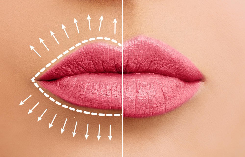 Reducción de labios