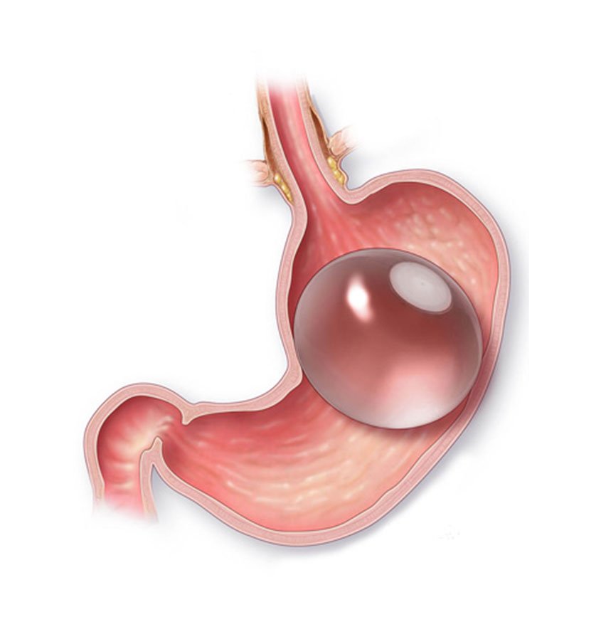 Procedimiento endoscopico de colocacion de balon gastrico en Cayra Clinic