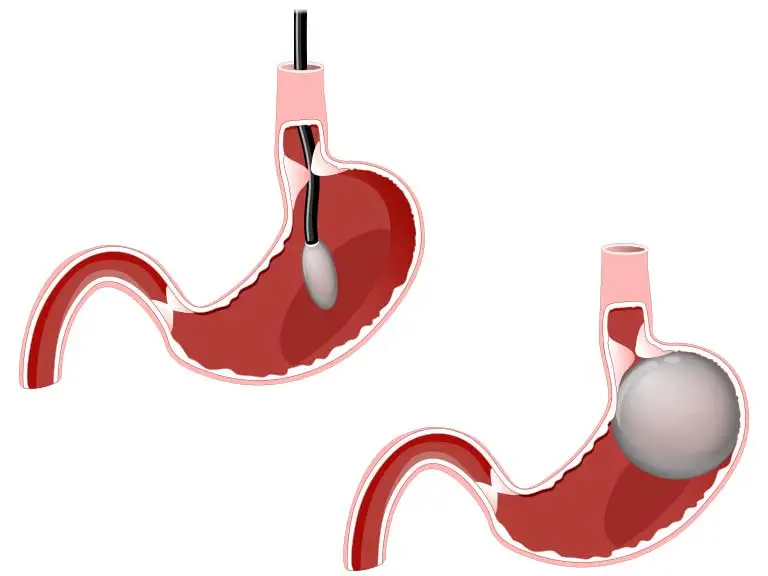 Procedimiento endoscopico de colocacion de balon gastrico en Cayra Clinic