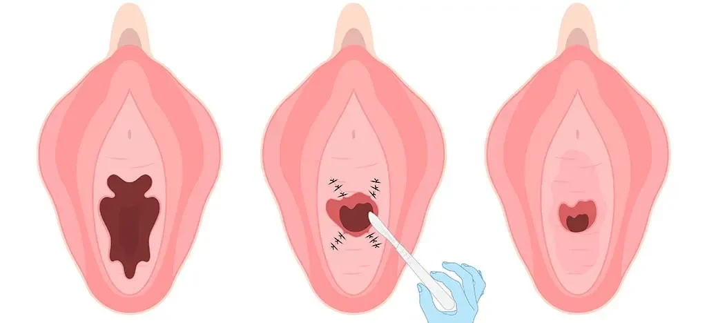 Estrechamiento Vaginal