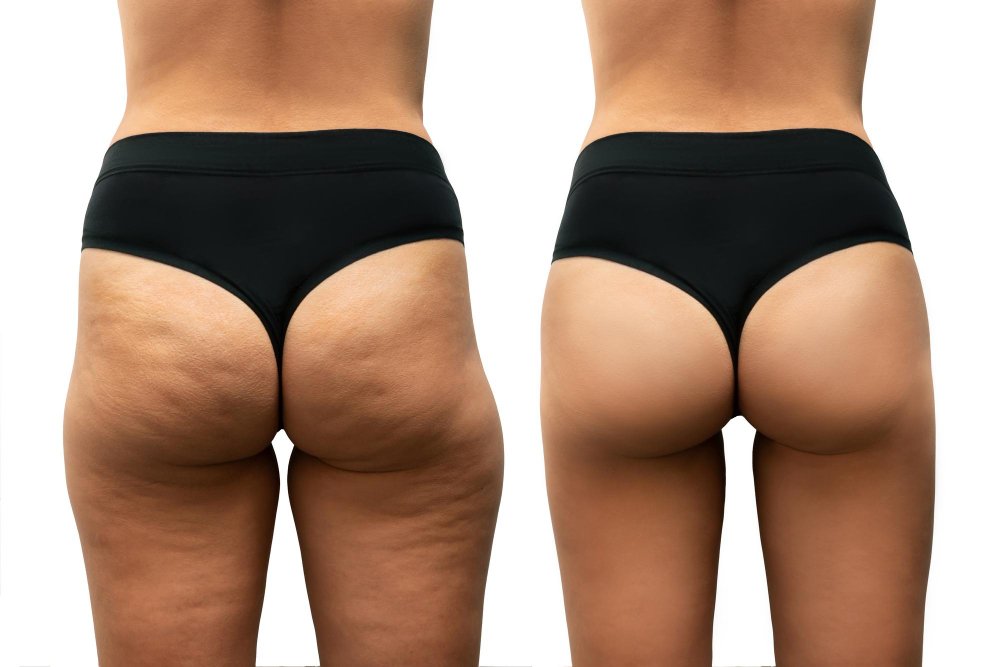lifting muslos antes y después