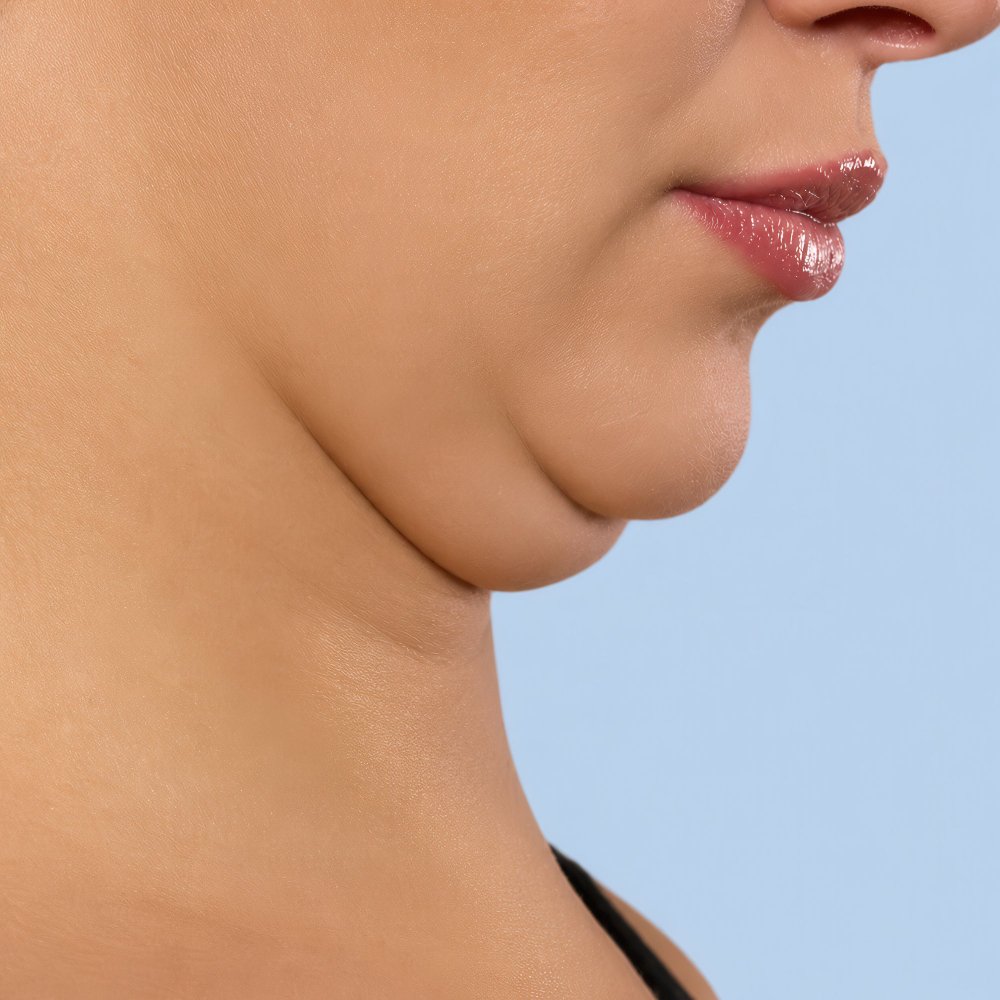 Liposucción de papada en Turquía para definir la mandíbula en Cayra