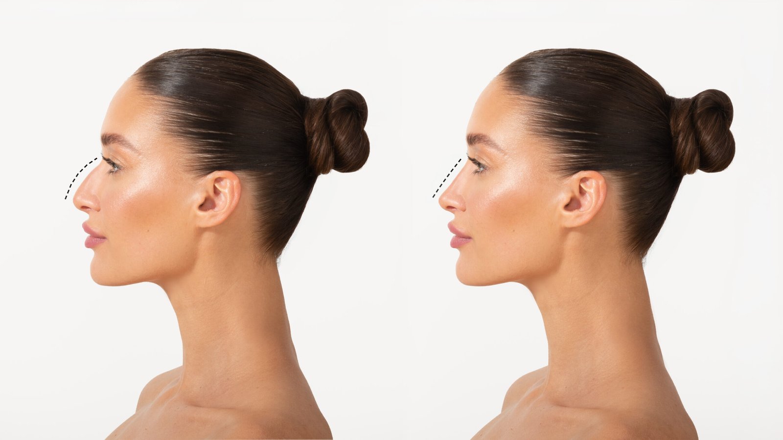 Procedimiento medico de rinoplastia no quirurgica en Cayra Clinic