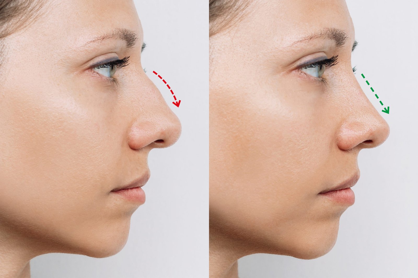 Tabla comparativa de precios de rinoplastia de revisión Turquía vs España