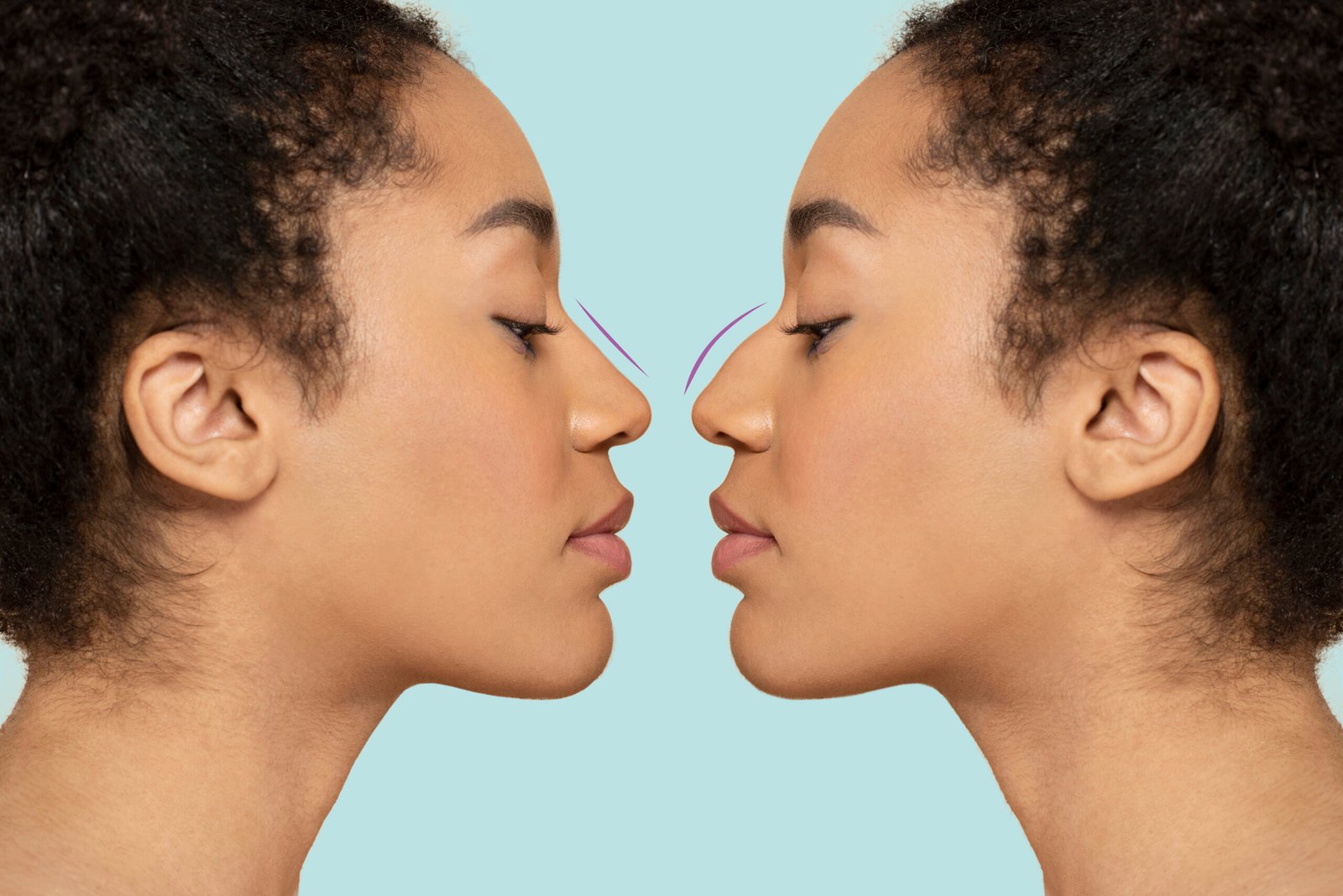 Procedimiento de cirugia nasal etnica en quirofano de Cayra Clinic