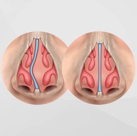 Procedimiento quirúrgico para corrección de tabique desviado en Cayra Clinic