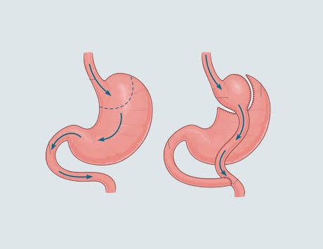 Quirofano acreditado por JCI para cirugia de bypass gastrico en Cayra Clinic