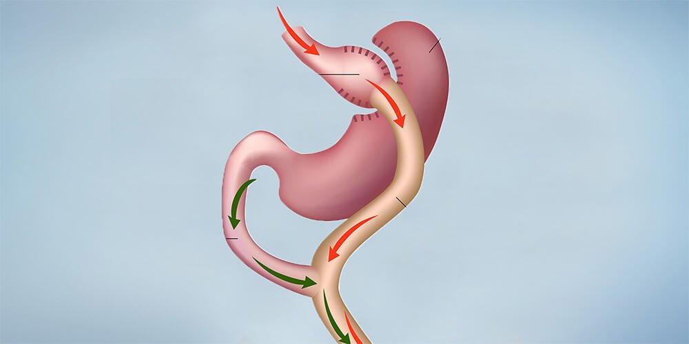 Tabla de IMC y criterios de elegibilidad para bypass gastrico en Estambul
