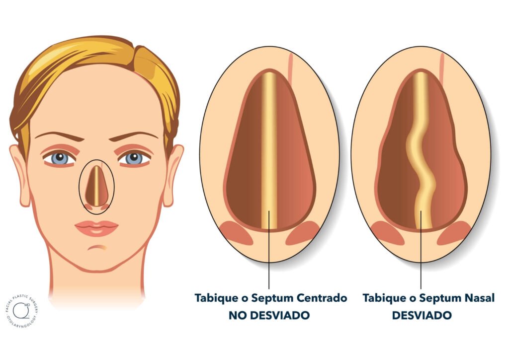 Tipos de desviacion septal y de cartílago nasal en Estambul