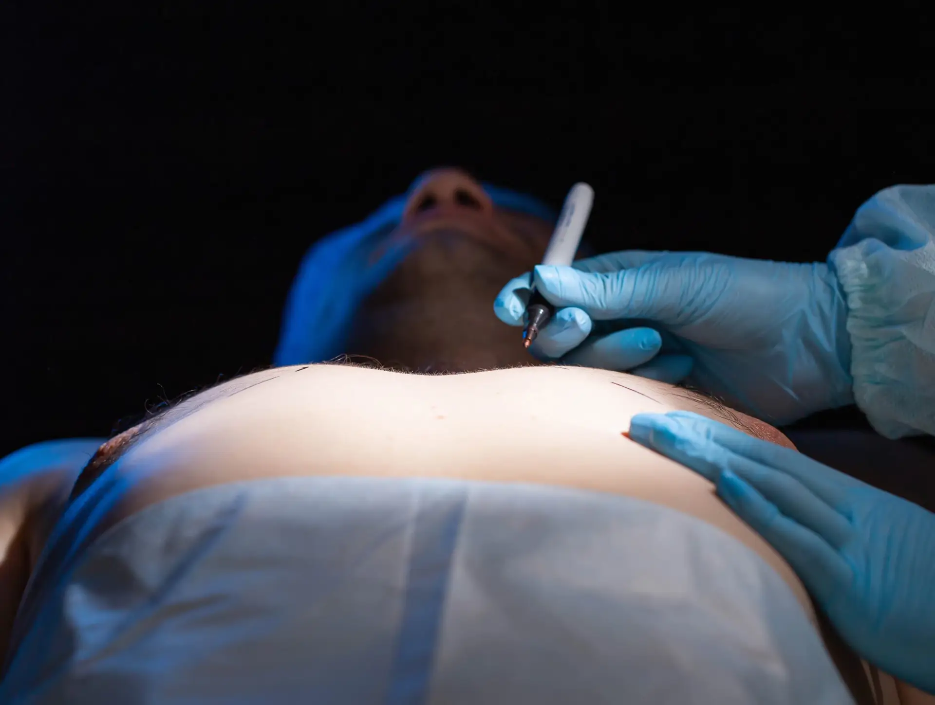 Intervencion quirurgica especializada para la extirpacion de glandula mamaria y liposuccion pectoral