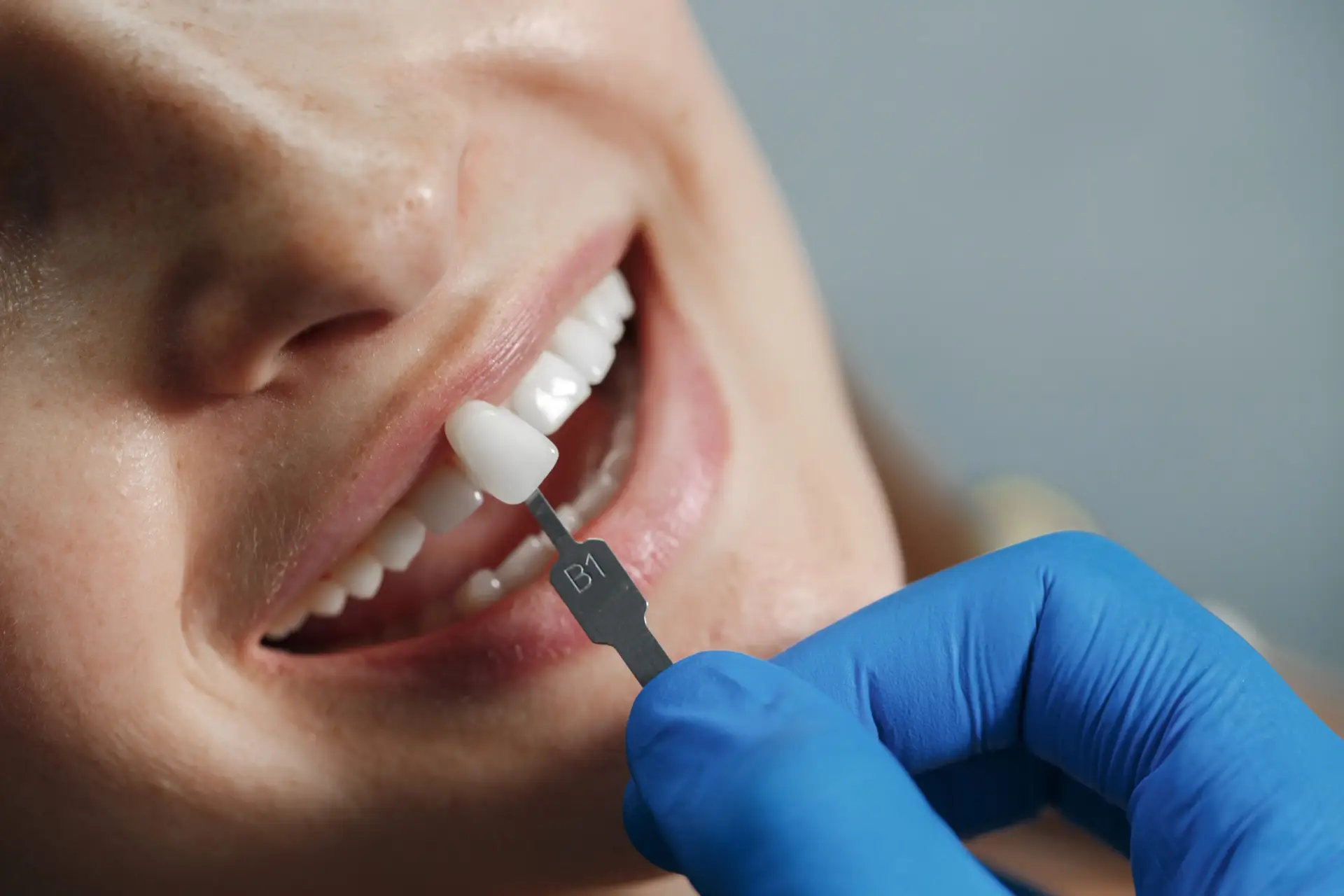 Tecnologia digital cad cam y diseno de sonrisa avanzado en clinica dental de Turquia