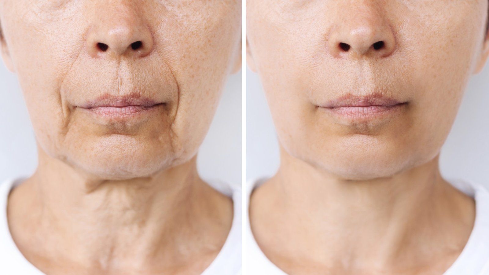 Resultados avanzados de lifting facial en clinica de cirugia plastica en Turquia
