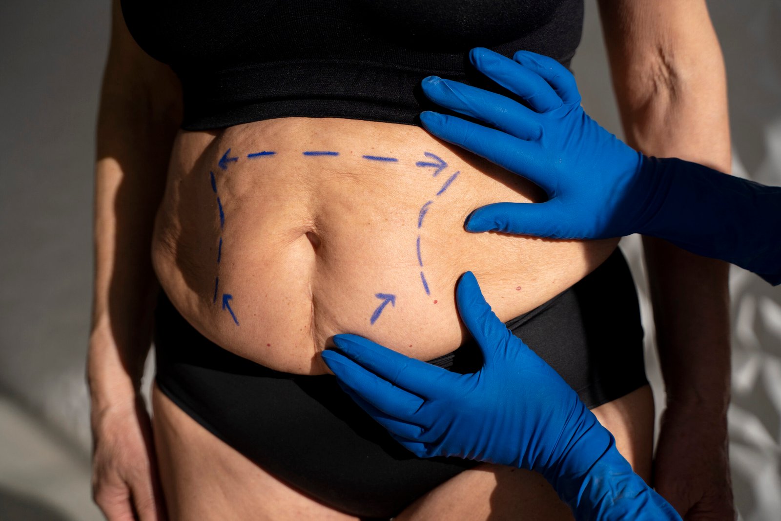 Analisis del orden quirurgico entre abdominoplastia y cirugia de mamas para solucionar la piel colgante