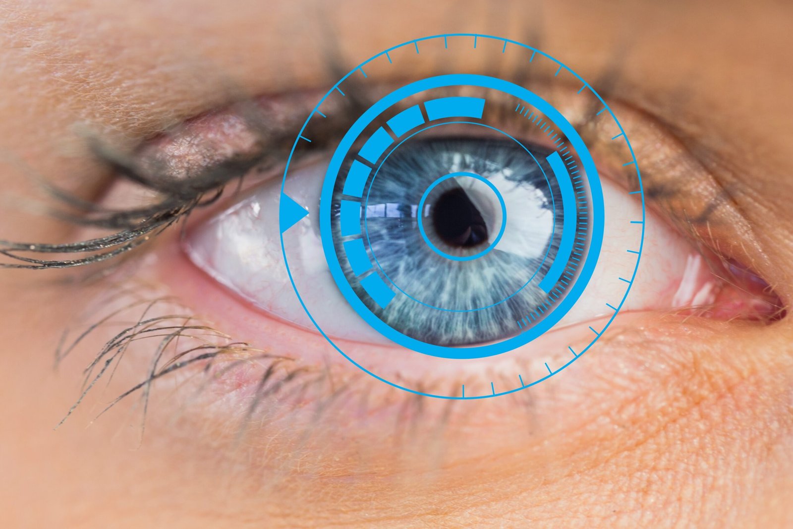 Intervencion quirurgica de microcirugia ocular para la implantacion de lente intraocular multifocal premium