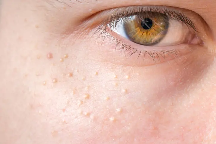 Procedimiento de lipofilling facial con microfat en Cayra Clinic