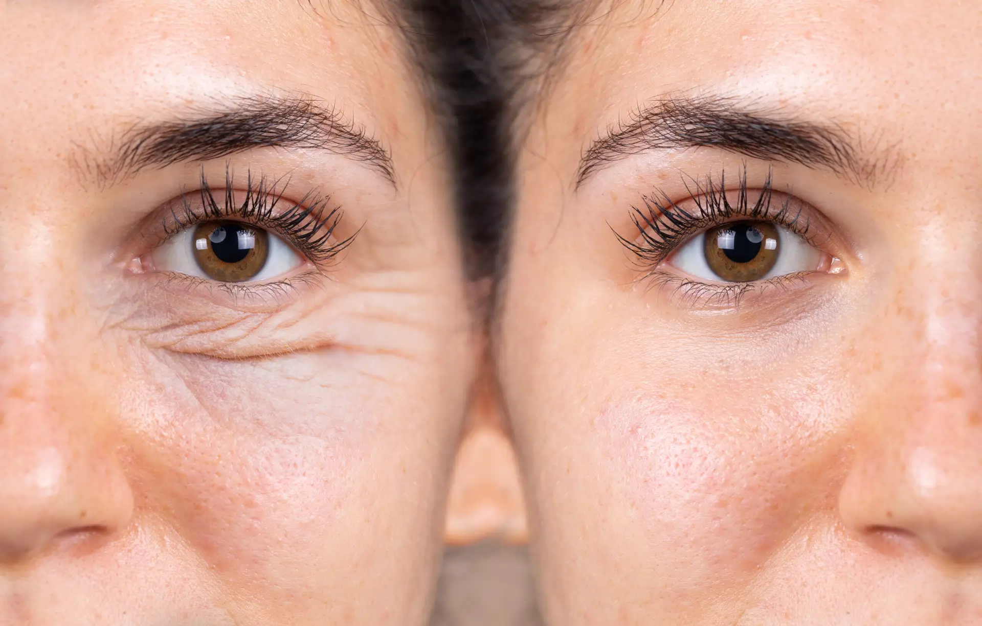 Intervencion quirurgica de blefaroplastia con maxima precision anatomica en el area periocular