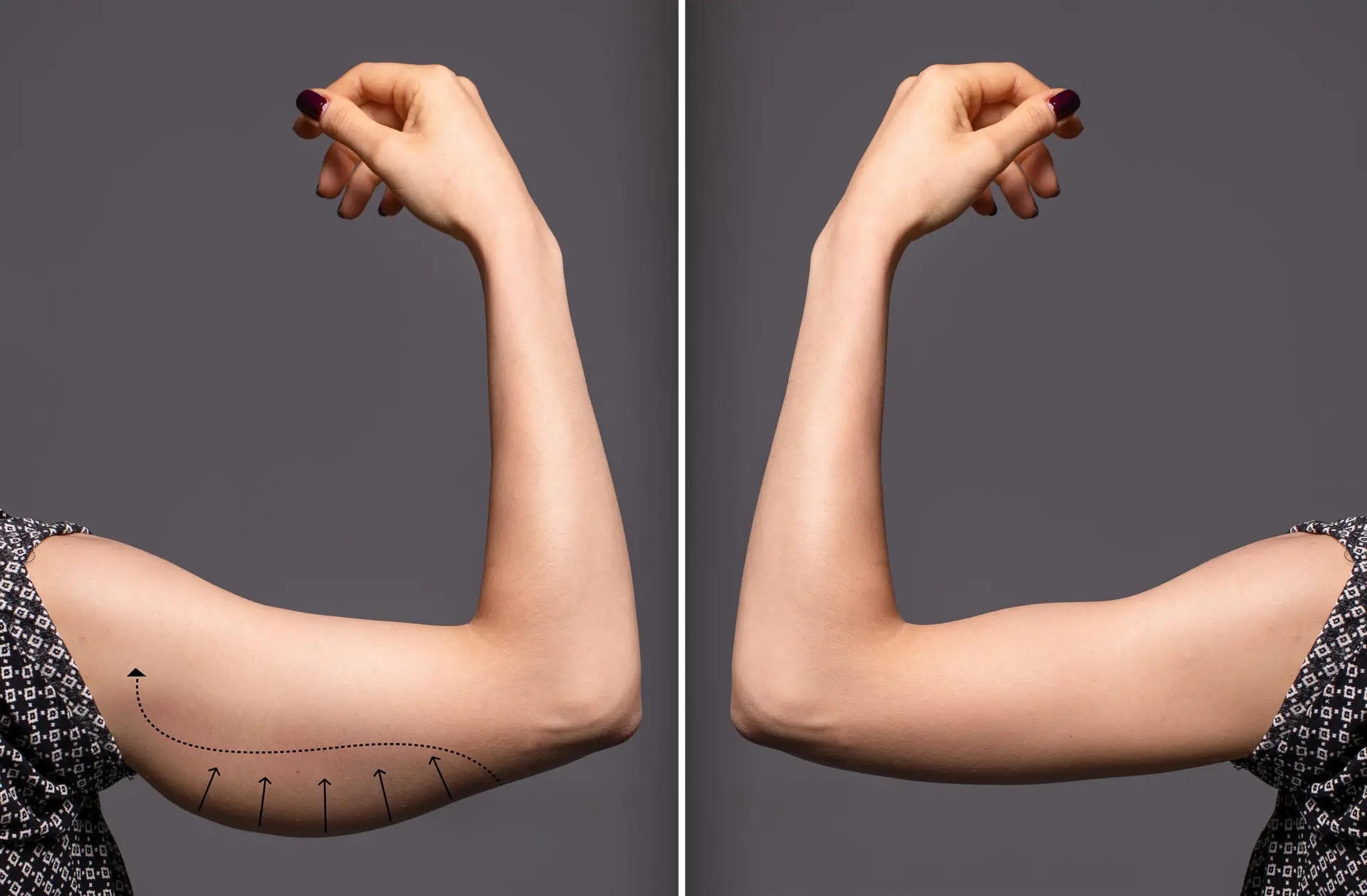 Intervencion quirurgica de lifting de brazos con maxima precision anatomica y suturas esteticas