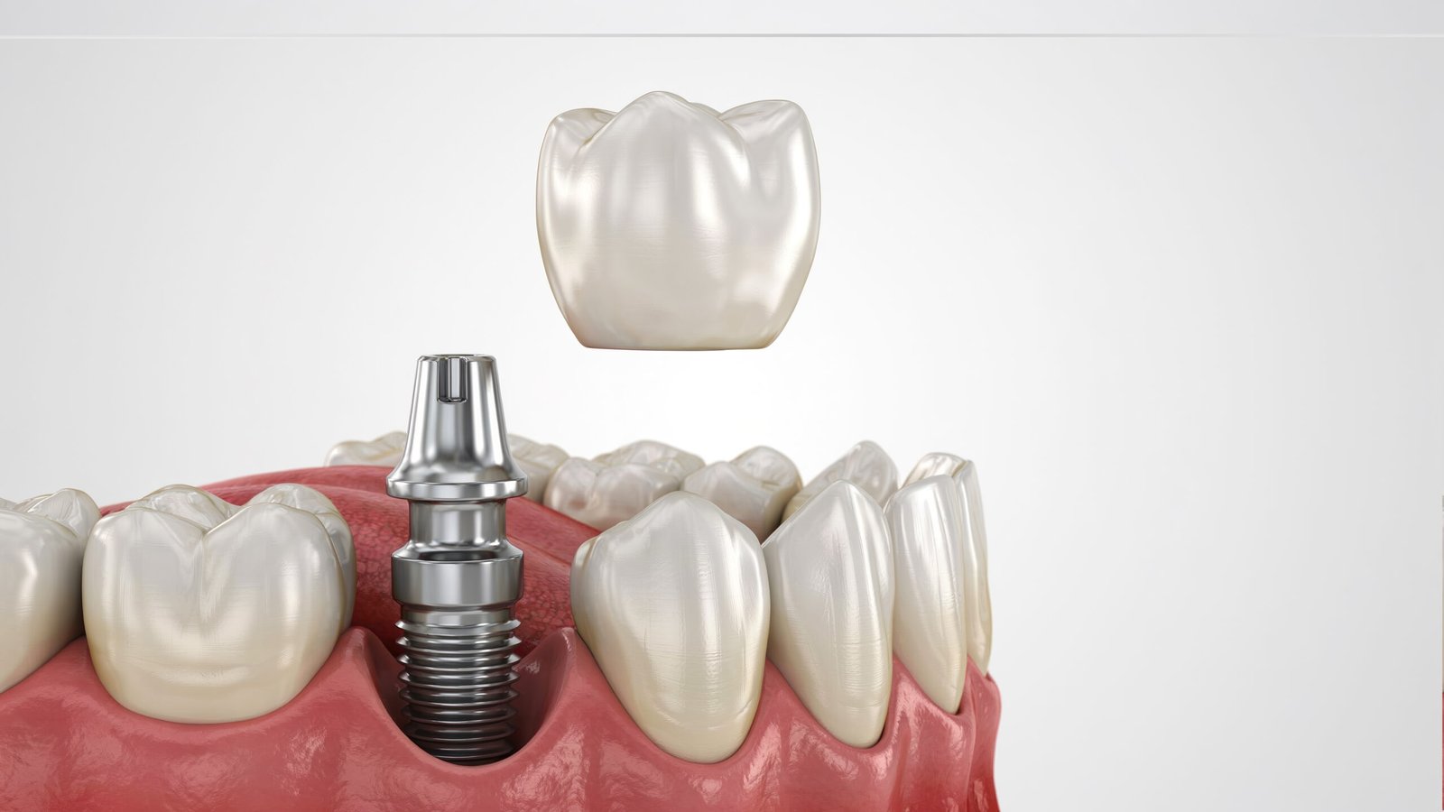 Intervencion quirurgica de precision para extraccion dental y colocacion de implante inmediato