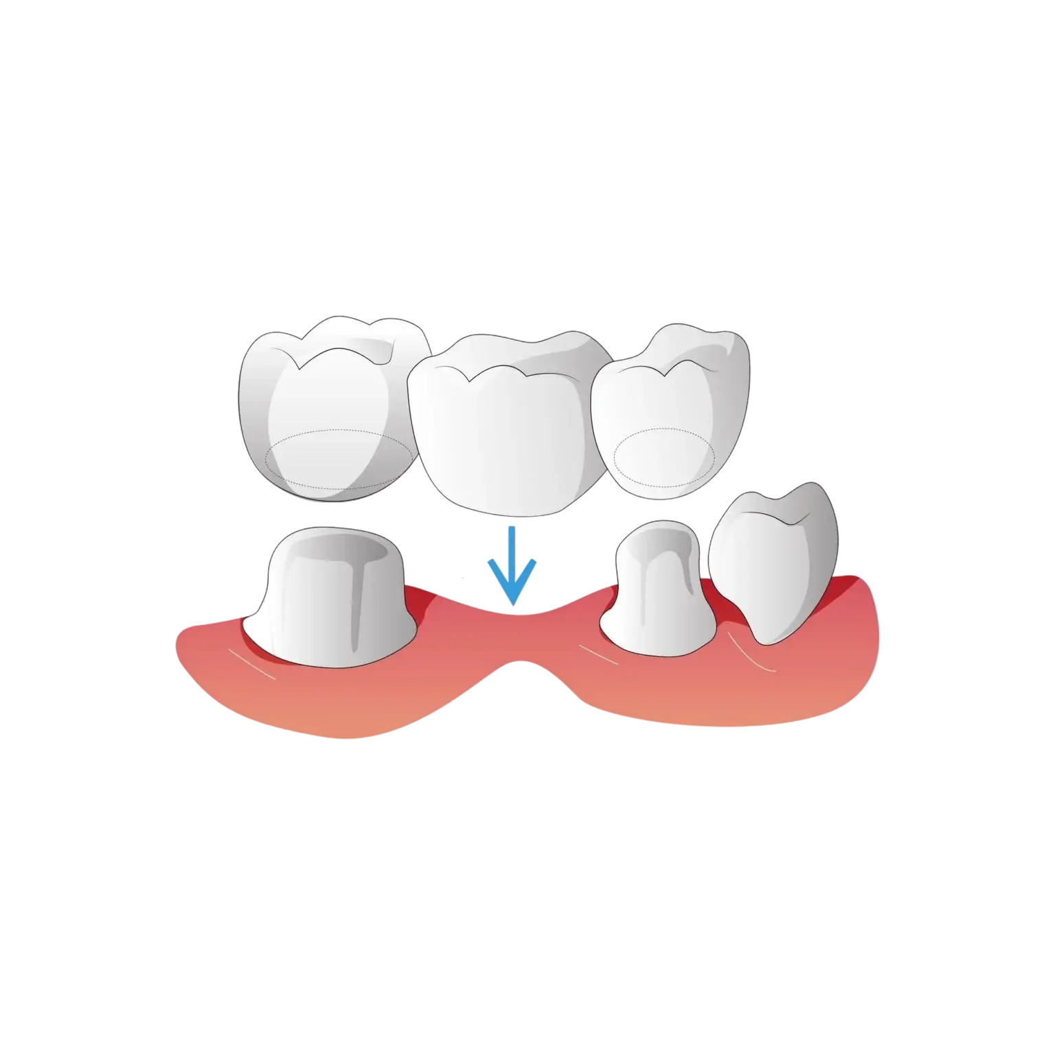 Intervencion quirurgica de precision para colocacion de implantes dentales oseointegrados