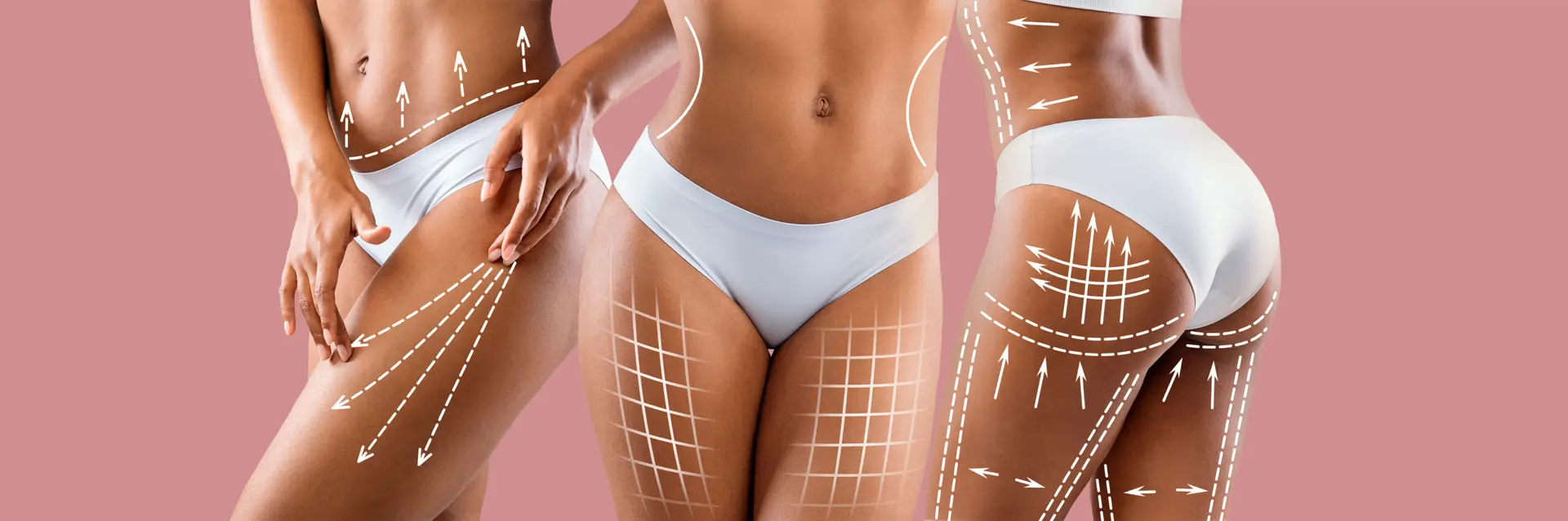 Planificacion quirurgica de liposuccion 360 y transferencia de grasa glutea segura