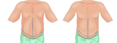Fleur-de-Lis-Tummy-tuck-photo-scar.webp Fleur-de-Lis-Tummy-tuck-photo-scar.webp
