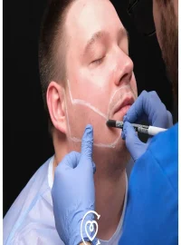 trasplante-de-barba-e1725093415416